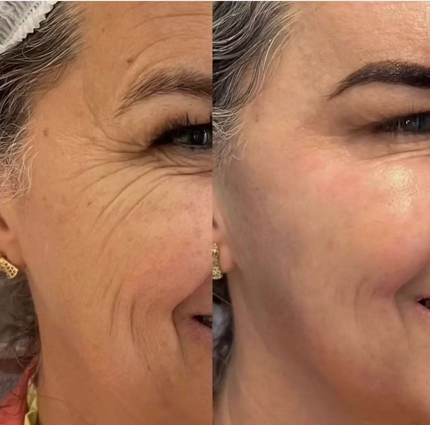 Resultado facial 1
